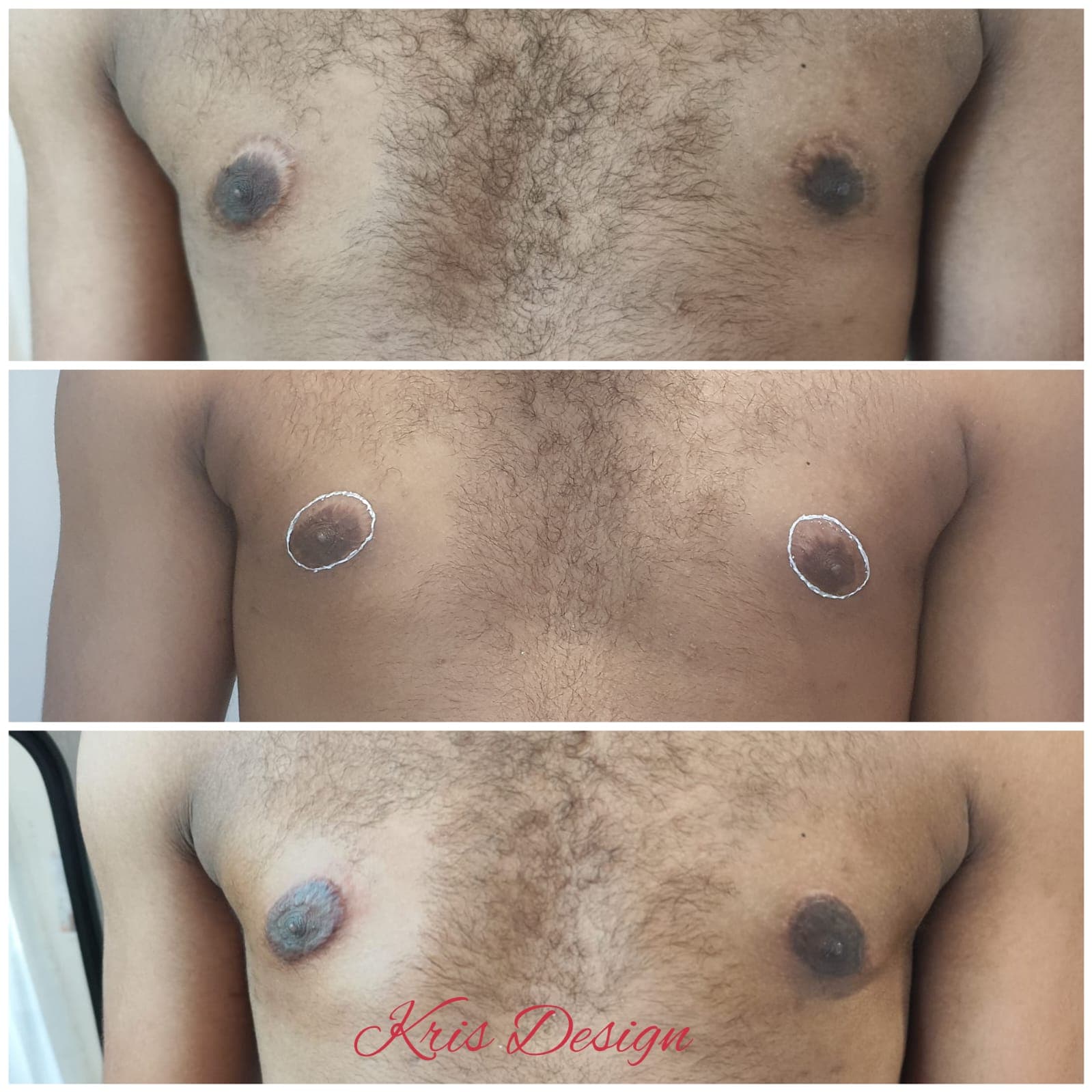 Dermopigmentation réparatrice.